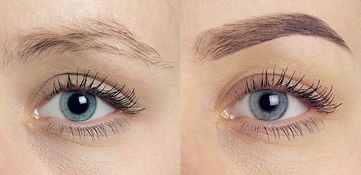 Eyebrow Hair Transplant Image