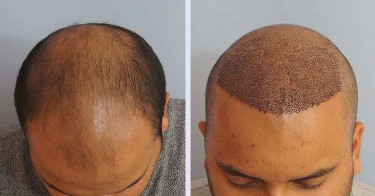 Hair Transplant Before And After Image 2