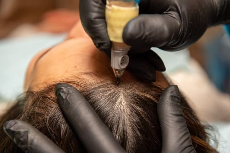 Scalp micropigmentation Image