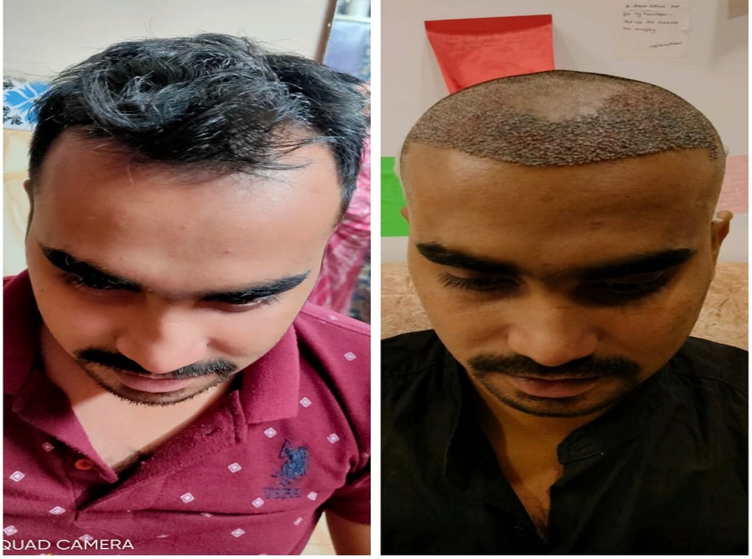 Hair Transplant result1