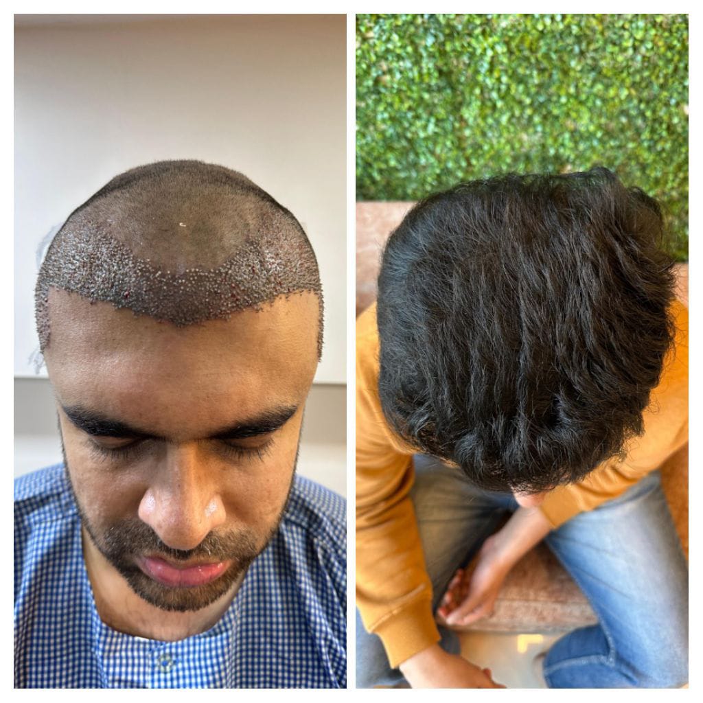 Hair Transplant result4