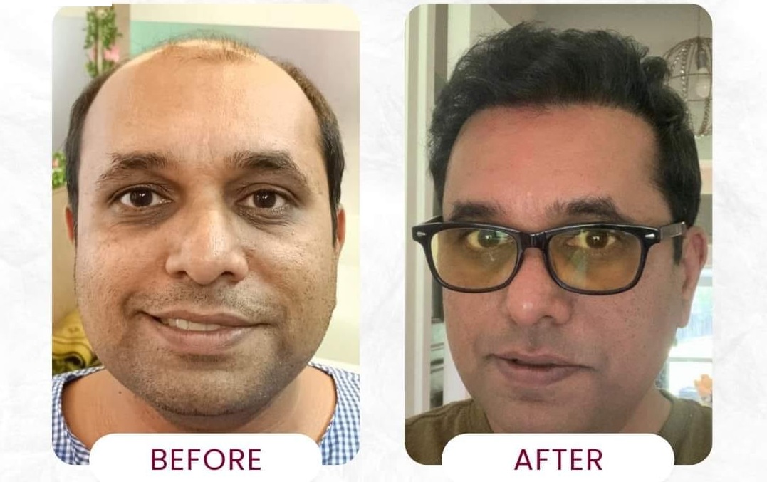 Lalchand Rajput Hair Transplant result