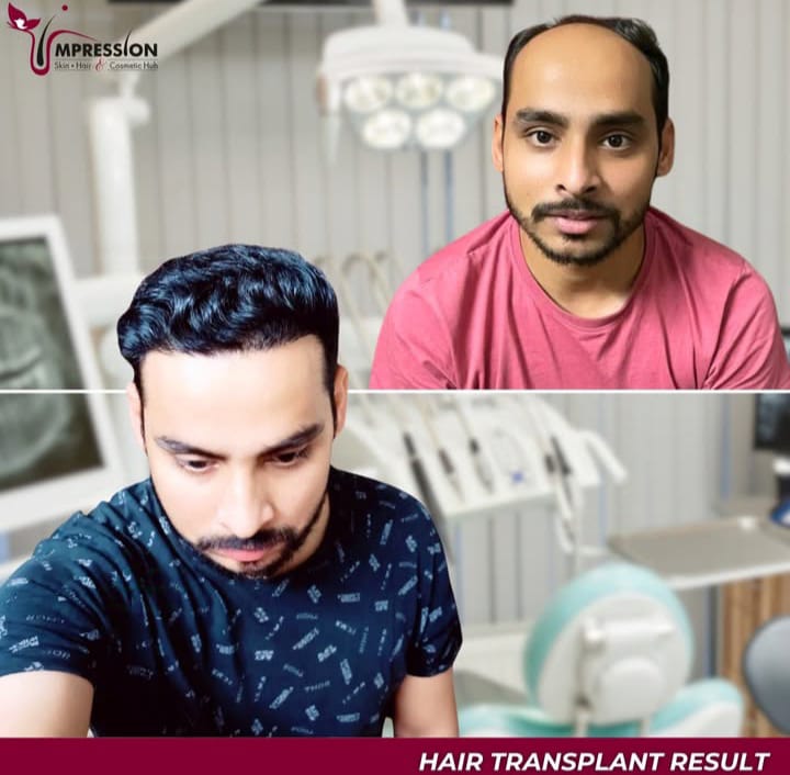 Hair Transplant result2