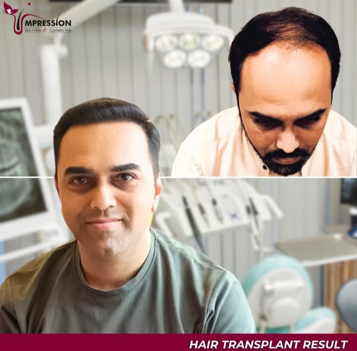 Hair Transplant result3