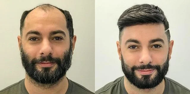 Vineet Sharma Hair Transplant result