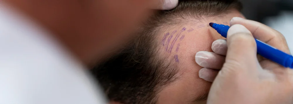 Best Hair Transplant