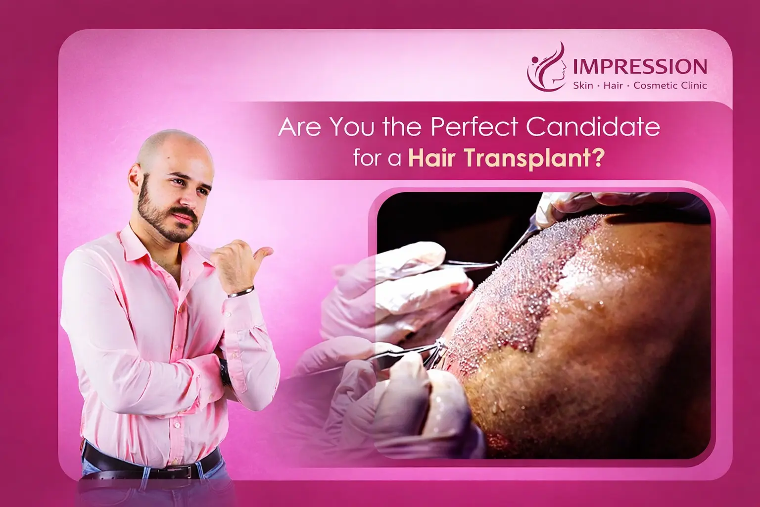 Ideal Candidate for Male Hair Transplant wp